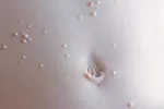 Qué es el molusco contagioso Niño con molusco contagioso