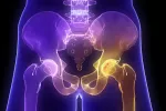 Osteoporosis Osteoporosis vista en un radiografía