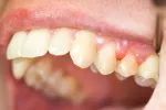 Periodontitis cardiovascular La periodontitis, factor de riesgo cardiovascular