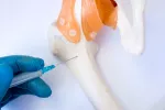 Qué es la biopsia de médula ósea Biopsia de médula ósea