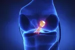 Rodilla con rotura del ligamento cruzado Diagnóstico de la rotura del ligamento cruzado