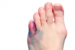 Signos y síntomas de una fractura de dedo Síntomas de una fractura de dedo