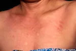 Mujer con dermatitis en el escote por alergia al níquel
