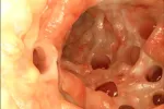 Síntomas de la diverticulosis