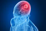 Estudian nuevos tratamientos contra el meduloblastoma Estudian nuevos tratamientos contra el meduloblastoma