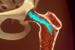 Los adipocitos de la médula ósea, una diana para combatir la leucemia Adipocitos de la médula ósea