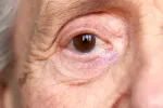 Asocian el alzhéimer con tres enfermedades de los ojos Mujer mayor con problemas de alzhéimer