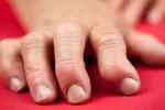 Crean un hidrogel que reduce la inflamación y el dolor de la artritis Artritis reumatoide