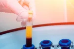 Hallan un nuevo biomarcador para diagnosticar diabetes gestacional Prueba de plasma