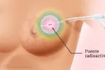 La braquiterapia reduce la duración del tratamiento del cáncer de mama Procedimiento de braquiterapia