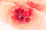 Cáncer de colon