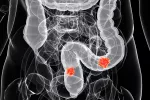 Aconsejan iniciar el cribado del cáncer colorrectal a los 45 años Cáncer colorrectal