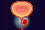 Dos fármacos prolongan la supervivencia en cáncer de próstata agresivo Ilustración del cáncer de próstata
