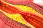 Asocian el aumento de lipoproteínas VLDL con más riesgo de diabetes Colesterol en la sangre, riesgo de diabetes