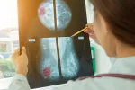 Un nuevo agente de contraste mejora el diagnóstico del cáncer de mama Diagnóstico de cáncer de mama ante una prueba de contraste