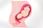 Parto prematuro El cuello uterino ayuda a predecir un parto prematuro