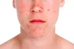 Adolescente con acné