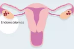 Una nueva técnica para tratar endometriomas preservaría la fertilidad Endometriomas