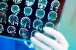 Hallan una molécula eficaz para el potencial tratamiento del ictus Radiografía del cerebro para un posible tratamiento del ictus