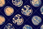 Identifican nuevas mutaciones genéticas asociadas a la esquizofrenia Escáner del cerebro