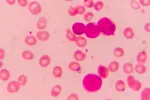 Leucemia al microscopio
