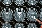 Logran frenar el crecimiento del glioblastoma, un grave tumor cerebral