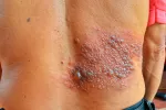 El herpes zóster aumenta el riesgo de ictus en mayores Espalda de un anciano con una infección por el virus del herpes zóster
