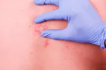 Antecedentes familiares, factor de riesgo del herpes zóster Antecedentes familiares, factor de riesgo del herpes zóster