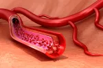 Las plaquetas altas podrían ser un indicador de riesgo de cáncer flujo sanguíneo