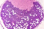 Identifican una nueva diana terapéutica para combatir la metástasis Imagen microscópica de la metástasis de los ganglios linfáticos