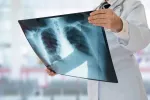 La UE establece nuevas normas contra la tuberculosis Radiografía de torax