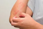 Nuevo fármaco biológico contra la psoriasis disponible en España Paciente sufre de psoriasis
