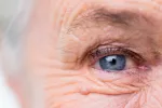 Cambios en los capilares de los ojos indicarían deterioro cognitivo Mujer mayor con problemas capilares oculares