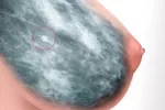 Una nueva terapia ‘cronifica’ un tipo de cáncer de mama Mamografía