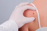 Un test predice eficazmente el riesgo de melanoma Melanoma en piel