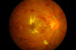 Un fármaco, eficaz frente al edema macular diabético Un fármaco, eficaz frente al edema macular diabético