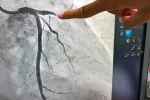 Angiografía Angiografía