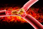 Arteriosclerosis Arteriosclerosis, cuida bien tus arterias
