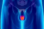 Balanitis Qué es la balanitis