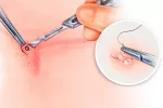 Biopsia cutánea Gráfico de una biopsia cutánea