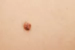 Cáncer de piel no melanoma Qué es el cáncer de piel no melanoma
