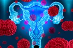 Cáncer de cuello de útero: prevenir para ganar la batalla Qué es el cáncer de cuello de útero