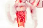 Cáncer de colon