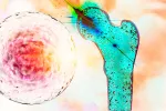 Cáncer de huesos Cáncer óseo
