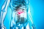 Cáncer de pancreas