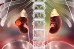 Cáncer de riñón Ubicación del cáncer de riñón