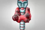 Cáncer de tiroides: síntomas Cáncer de tiroides