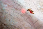 Qué es la fiebre de chikungunya Chikungunya