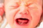 Anquiloglosia Anquiloglosia