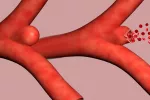 Aneurisma